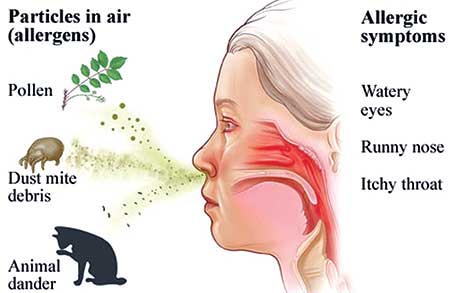 Rinitis alérgica: causa, síntomas y tratamiento.